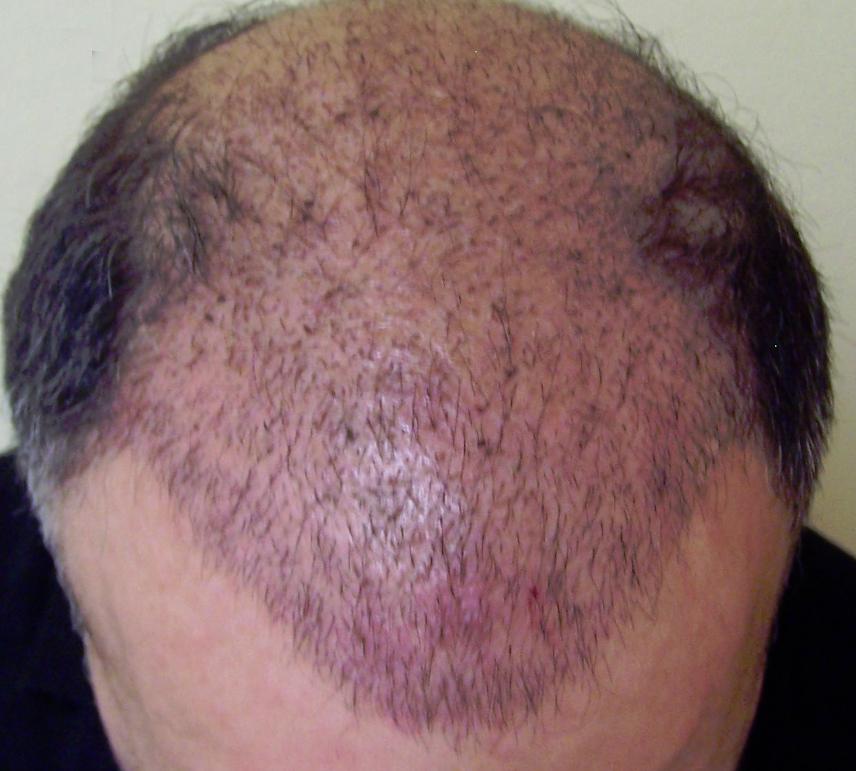 naturally regrow lost hair